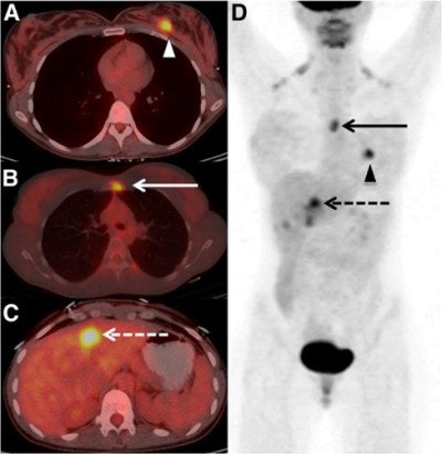 Images are from a 29-year-old woman with stage IIA breast cancer that was upstaged to stage IV by FDG-PET/CT. Axial PET/CT images showed known (A) primary left breast cancer (arrowhead), previously unknown (B) osseous metastasis (solid arrow), and previously unknown (C) liver metastasis (dashed arrow) proved by biopsy. PET also provided an overview of all lesions (D). Images courtesy of JNM.