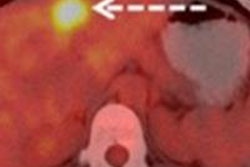 2014 09 16 21 43 48 919 Pet Ct Breast Jnm Ulaner 400 20140917045321