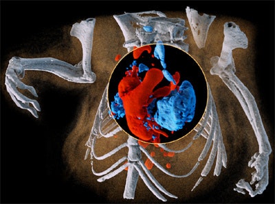 Multispectral imaging on a small scale: 3D image of mouse showing bone (white), iodine in the cardiovascular system (red), and barium in the lungs (blue). All images courtesy of Dr. Anthony Butler, PhD.