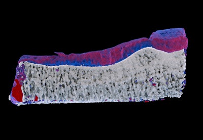 Measurements of biochemistry on the MARS preclinical spectral scanner enable early detection of arthritis. Red represents diseased cartilage; blue represents healthy cartilage. On traditional x-ray imaging, both areas are 'gray,' so arthritis can only be measured when the cartilage has been destroyed. The work was done in partnership with the University of Otago medical school's radiology and orthopedics departments.