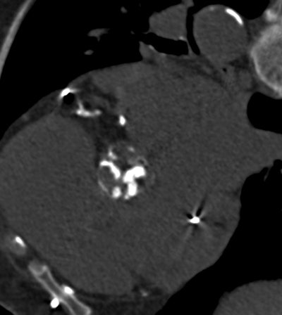 Aortic valve calcification is easily discernible at MDCT in a patient with extensive calcifications. Image courtesy of Dr. Maurice Enriquez-Sarano.
