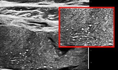 Punctate reflectors predominately on the fetal side of the placenta, the earliest indicator of emerging small-vessel disease.
