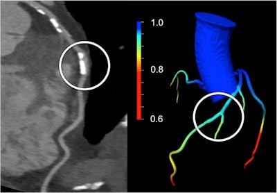 A calcified stenosis in the middle left anterior descending (LAD) artery seen on CCTA (left) was suspected to be significant. However, CT-based FFR demonstrated the absence of lesion-specific ischemia by the color-coded coronary artery tree model (right), which was confirmed by subsequent coronary catheter angiography with invasive FFR derivation. Image courtesy of Dr. Matthias Renker and Dr. U. Joseph Schoepf.