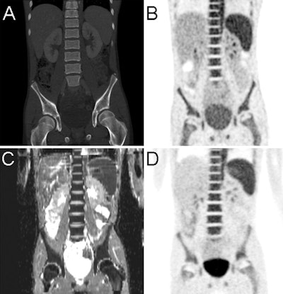 Images are of a 14-year-old patient with non-Hodgkin's lymphoma and bone marrow infiltration. PET from PET/CT (B) and PET from PET/MRI (D) show increased bone marrow uptake, paralleled by diffusion restriction shown on the apparent diffusion coefficient map (C). CT (A) findings of the PET/CT examination were inconclusive. Images courtesy of Radiology.