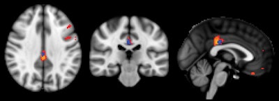 ASL-MRI showed decreased relative cerebral blood flow in the posterior cingulate cortex in subjects with deteriorated cognitive function versus those with stable cognitive function. Image courtesy of Radiology.