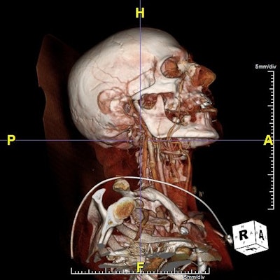 Patient was brought to a Houston emergency room with an arrow implanted in the area of the clivus. The arrow had been shot via crossbow. Dr. Mas Takashima, associate professor of otolaryngology and head and neck surgery at Baylor College of Medicine and associate professor of neurosurgery, performed a presurgical evaluation of the patient via the Plato's Cave interactive visualization platform. Takashima evaluated the optimal method to remove the arrow and prevent bleeding and potential cerebrospinal fluid leakage, finally removing the arrow without adversely affecting the patient, who is alive and doing well.