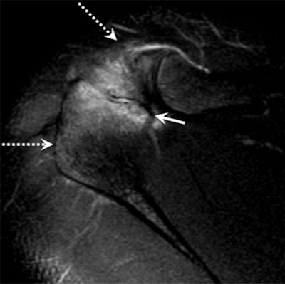 Image above shows incomplete fusion with moderate bone marrow edema in an 18-year-old male pitcher with acromial apophysiolysis. MR image below in the same patient at age 25 after quitting pitching shows complete fusion and resolution of the previously seen acromial edema (dashed arrows). Images courtesy of Radiology.