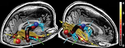 Reconstructed MR image shows the right arcuate (blue tracks and arrows) and inferior longitudinal fasciculus (ILF) (yellow tracks and arrows) in a representative subject. The track profile is colored according to fractional anisotropy, showing that the maximal increase in fractional anisotropy is in the anterior arcuate and ILF. The red, blue, and green spheres correspond to size and locations of increased cortical thickness in the right occipital, precentral, and middle temporal regions, respectively. The green arrows also point to the middle temporal region of increased thickness. Image courtesy of RSNA.