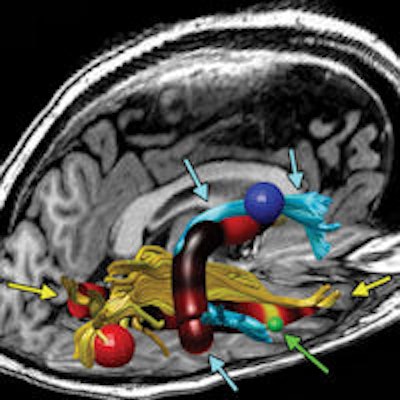 2014 10 28 15 59 47 166 Rad Mri Fatigue Image 01 200