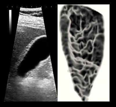 Patient with severe chronic focal cholecystitis. Left: 5-MHz narrow-sector, high-persistence image. Right: cutaway, magnified, reversed-phase 3D surface rendering showing the sinuous fibrotic scarring of the anterior lumen. All images courtesy of Dr. Jason Birnholz.