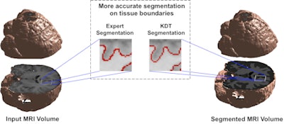 Brain segmentation is improved with use of the KDT method. Image courtesy of Nishant Verma, PhD.
