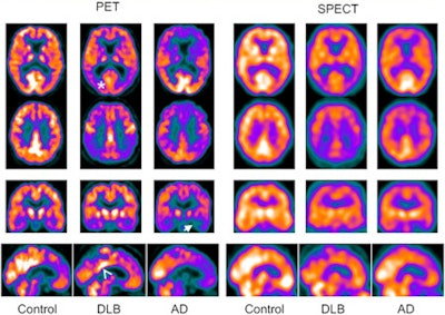 FDG-PET and SPECT scans for Alzheimer's disease (AD), dementia with Lewy bodies (DLB), and control subjects. The scans show medial temporal loss in Alzheimer's subjects (arrow) and occipital lobe reduction (asterisk) and posterior cingulate island sign (arrowhead) in DLB subjects. Image courtesy of JNM.