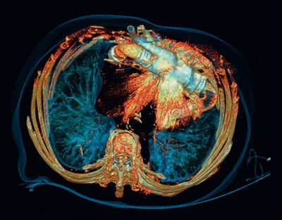 Follow-up study after a cardiac pump implantation. The two volume-rendered images show that the severe artifacts caused by the implanted pump (above) are significantly reduced by the iMAR reconstruction technique, and the surrounding anatomical structures can be clearly visualized (below). Copyright: University Erlangen-Nuremberg, Erlangen, Germany.