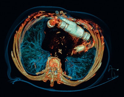 Edge CT cardiac image