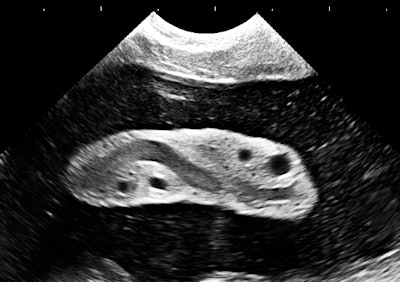 A 2D sector image from a routine exam at 19-weeks gestational age. Image courtesy of Dr. Jason Birnholz.