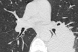 2014 12 01 11 08 59 352 Milch Lungcancer 400 20141201181210