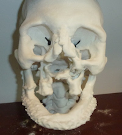 3D-printed facial model. Image courtesy of RSNA.