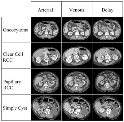 The various lesion types included in the study, imaged in three CT phases. Image courtesy of Dr. Siva Raman.