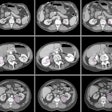 2014 12 02 18 00 53 987 Raman Kidneylesions 200