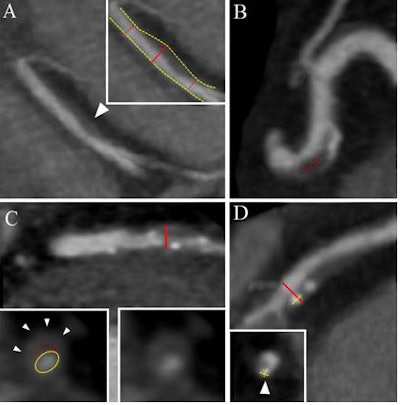 Positive remodeling was defined using the threshold of 1.1 for the maximal diameter of the vessel at the plaque over the diameter of the proximal and distal normal vessel reference (A). Low HU plaque consisted of the mean HU number within three regions of interest less than 30 HU (B). The napkin-ring sign is a ringlike peripheral higher attenuation surrounding a central core of low attenuation of a noncalcified coronary plaque (C). Spotty calcium was defined as calcified plaque with a maximum diameter less than 3 mm in any direction, length of the calcification less than 1.5 times the vessel diameter, and width of the calcification less than two-thirds of the vessel diameter (D). Image courtesy of Dr. Stefan Puchner.
