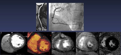 Left to right: Rest single-energy CT does not show perfusion defect in left ventricular myocardium. Stress DECT shows perfusion defect in midinferoseptal and inferior wall, corresponding to right coronary artery territory. Rest and stress perfusion MRI confirmed the reversible perfusion defect in right coronary artery territory. No myocardial infarction was seen in the left ventricular wall on delayed contrast-enhanced MRI. Image courtesy of Dr. Sung Min Ko.