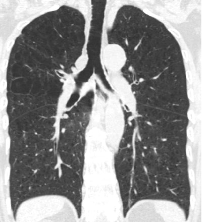 CT scan of lung showing emphysema. Image courtesy of Dr. Elizabeth Oelsner.