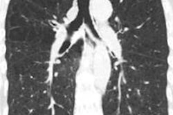 2014 12 15 15 08 58 628 2014 12 15 Emphysema Oelsner 400 20141215221055