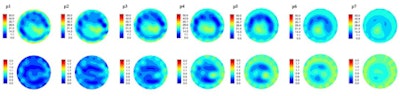 Images acquired by microwave tomography system demonstrate electrical property distribution of a cancer patient's left breast, taken somewhat into her therapy. The breast outline and the features inside the breast that relate to fibroglandular tissue inside the adipose tissue can be visualized. This breast has undergone treatment and so most of the tumor has disappeared. Image courtesy of Neil Epstein and the University of Calgary.