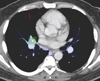 Above and below, examples of correctly stationed lymph nodes.
