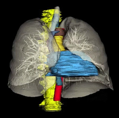 Eight automatically segmented organs include the spine, trachea and lungs, esophagus and aortic arch, pulmonary trunk, ascending and descending aortas, superior vena cava, azygos arch, and heart. All images courtesy of Dr. Ronald Summers.