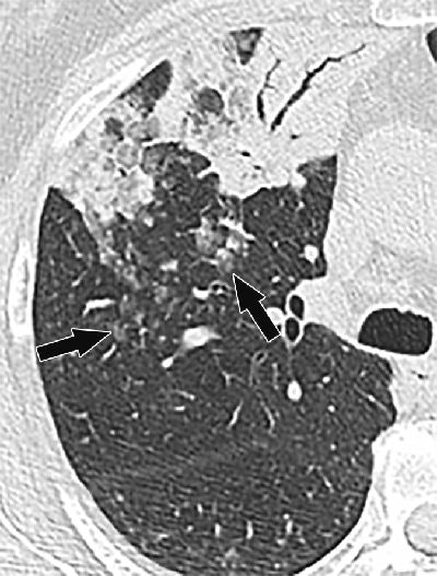 CT image shows primary lung invasive mucinous adenocarcinoma in right upper lobe presenting as air-space consolidation with air bronchograms in 68-year-old man. Ill-defined centrilobular nodules (arrows) with ground-glass attenuation are present posterior to lesion.
