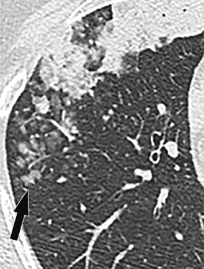 CT features of aerogenous spread of tumor. Image shows primary lung adenocarcinoma in right middle lobe presenting as air-space consolidation in 49-year-old female nonsmoker. Centrilobular nodules (arrow) and acinar opacities are present away from primary lesion in different bronchial territory. Images republished with permission of the American Roentgen Ray Society.