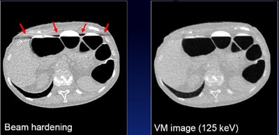 Virtual monochromatic images reduce beam-hardening artifacts. All images courtesy of Janne Nappi, PhD.