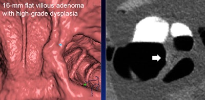 A 16-mm flat villous adenoma was detected by the virtual monochromatic image CAD scheme, but not the single-source CAD.