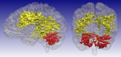 T1 rho MRI scans show brain regions of elevated signal in 15 patients with bipolar disorder compared to 25 control subjects. The primary regions of difference are the cerebral white matter (yellow) and the cerebellum (red). Image courtesy of the University of Iowa.