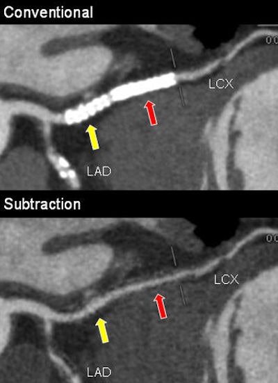 Top, 67-year-old man with two 3-mm stents placed in left circumflex (LCX) artery seen in conventional coronary CTA. Above, luminal patency became evident with subtraction. Below, patency is confirmed with invasive coronary angiography. All images courtesy of Dr. Makoto Amanuma.