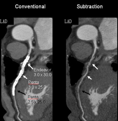 Left, patient has one 2.5-mm stent and two 3-mm stents. Right, luminal patency became evident with subtraction for all three stents.