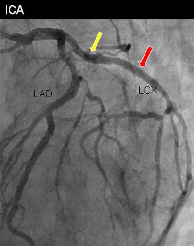 Stents on CTA