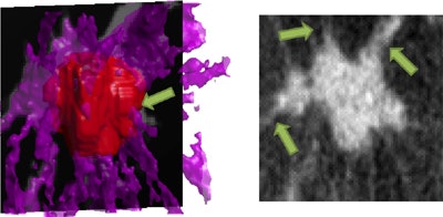 Segmentation of spiculated breast lesion image. Red (left) represents the segmented lesion (expanded for illustration), while purple (anything that appears white in the CT scan) represents tissue classified as fibroglandular. When there's a spiculation (gray at right, or appearing as purple tissue at left), it 'pierces' the red surface because it is connected to the lesion. The spiculation index counts how often the red surface is pierced. Images courtesy of Ingrid Reiser, PhD.