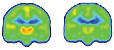 Images created by averaging PET scan data from chronic pain patients (left) and healthy controls (right) reveal higher levels of inflammation-associated translocator protein (orange/red) in the thalamus and other brain regions of chronic pain patients. Images courtesy of Marco Loggia, PhD.