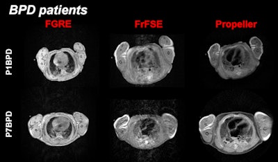MR images show a more severe case of BPD in the lower row of images (P7BPD). The structural differences are best differentiated in the FGRE sequence and with motion correction by PROPELLER.