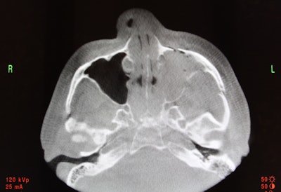 Preoperative CT scan