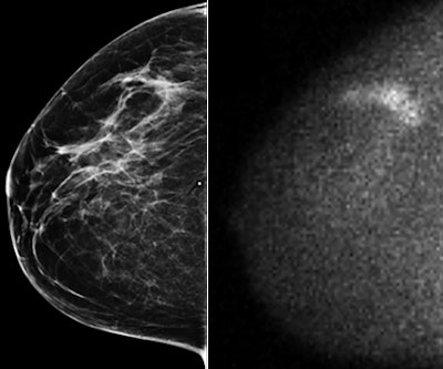 Mammographically occult invasive lobular carcinoma detected by MBI in a 54-year-old woman. Right craniocaudal image (at left) from digital screening mammography was interpreted as negative. Adjunct craniocaudal MBI image (at right) was interpreted as multifocal area of marked radiotracer uptake in upper outer right breast. Final pathology was multifocal node-negative grade I invasive lobular carcinoma more than 4 cm in extent on MBI, with largest individual mass being 0.6 cm. Images reprinted with permission from AJR.