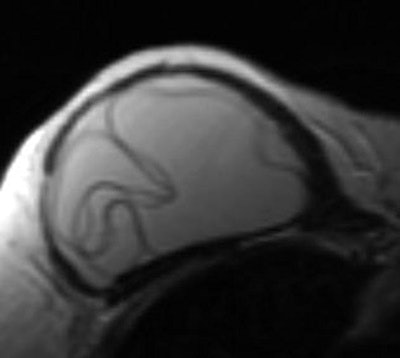 Breast MRI showing the linguine sign indicating intracapsular implant rupture.