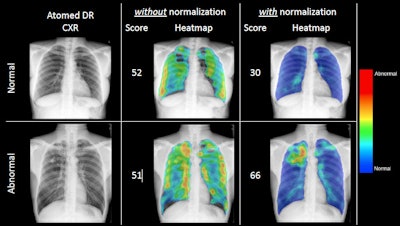 The application of energy normalization improved CAD's ability to distinguish normal (top row) from abnormal (bottom row) chest radiographs.