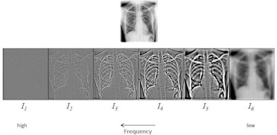 To standardize the appearance of chest x-rays, the image is decomposed into frequency bands using a process of hierarchical unsharp masking. In a training set, the average energy or standard deviation of each frequency band in the central part of the image is determined. All bands are then scaled to this reference energy, and the input image is reconstructed from the scaled frequency bands. After energy normalization, the chest radiographs look much more similar to each other. All images courtesy of Rick Philipsen.