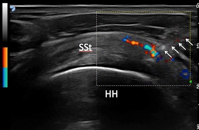 Ultrasound-guided injections of PRP in the supraspinatus tendon. Needle is shown with arrows and the spread of PRP is visible on color Doppler. All images courtesy of Dr. Francesco Arrigoni.