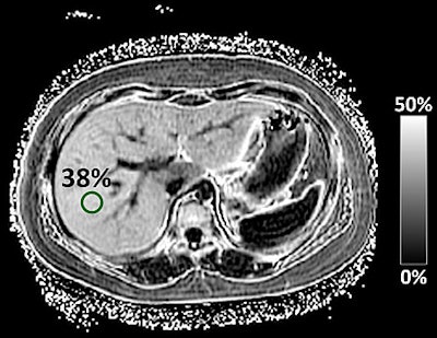 MR image of a child’s liver with severe NAFLD. The liver is 38% fat, compared with a normal level of 1%. Image courtesy of UCSD School of Medicine.