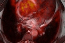 2015 02 09 14 23 53 286 Ssfp Atrium Pet Mri Nensa 200