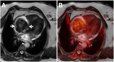 SSFP MR image (A) shows large intracavitary tumor in right atrium (arrows), causing dyspnea and thoracic pain. The fused PET image (B) illustrates mediocre FDG uptake in the tumor (SUVmax of 3.8). Histopathology confirmed the PET/MRI diagnosis of myxoma. Images courtesy of JNM.